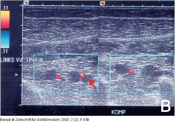 Tiefe Beinvenenthrombose - Duplexsonographie