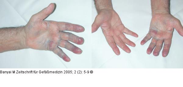 Angiodysplasie