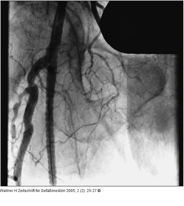 Implantierter Stent