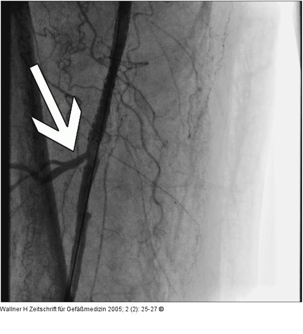 Implantierter Stent