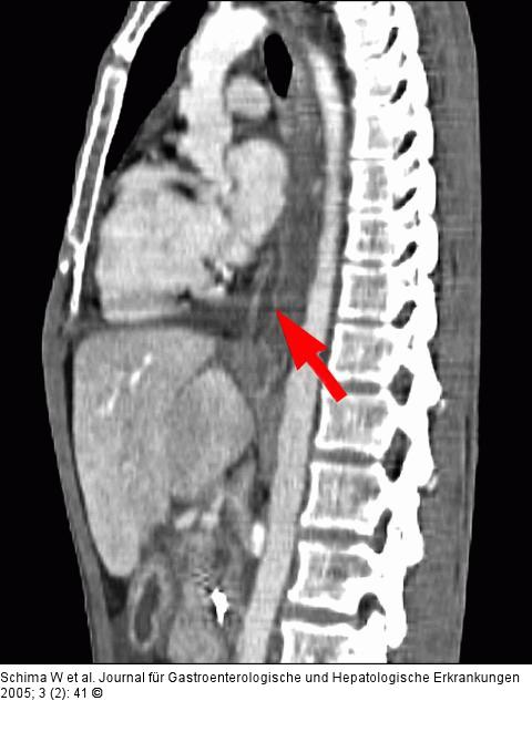 Coronale MDCT-Rekonstruktion der Fistel