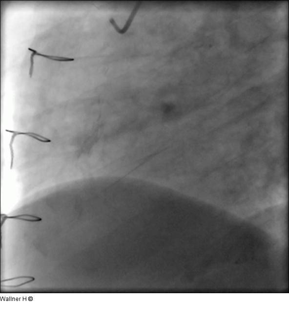 Saphena Vena Graft auf die rechte Kranzarterie (RAO 60/0)
