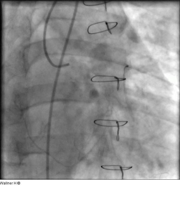 Saphena Vena Graft auf die Arteria circumflexa (RAO 60/0)
