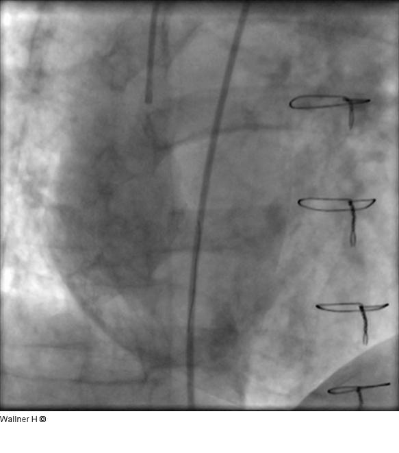 Direkt-Stenting