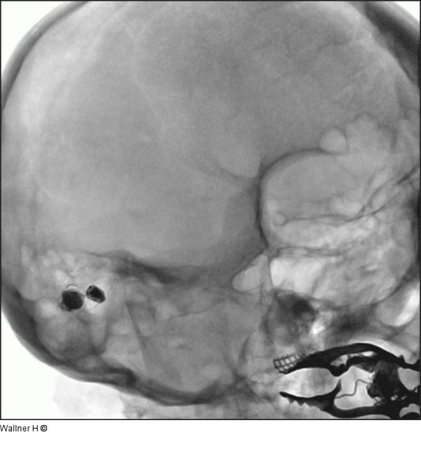 Intrazerebrale Angiographie