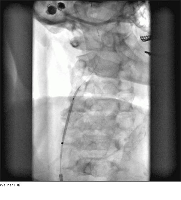 Stent - Freisetzung