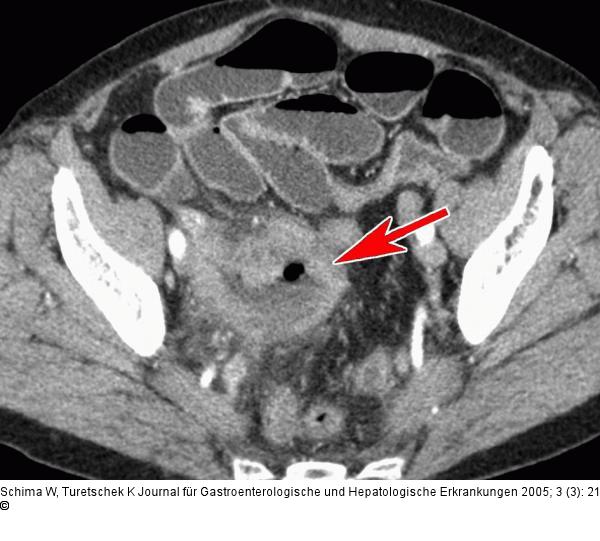Tumor - Ileum