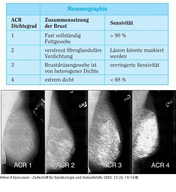 Mammographie - ACR