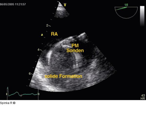 Rechtsatriale Thrombose nach 2-Kammer-Schrittmacherimplantation