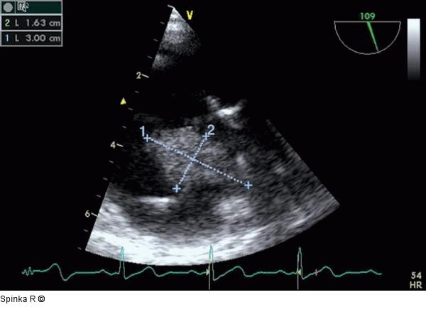 Rechtsatriale Thrombose nach 2-Kammer-Schrittmacherimplantation