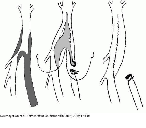 Profundaplastik