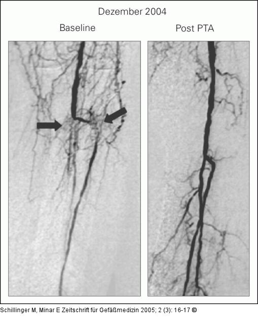 Ballon-Angioplastie