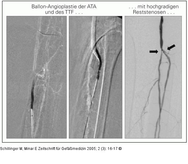 Ballon-Angioplastie
