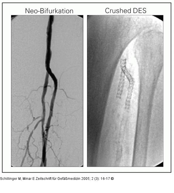 Angiogramm