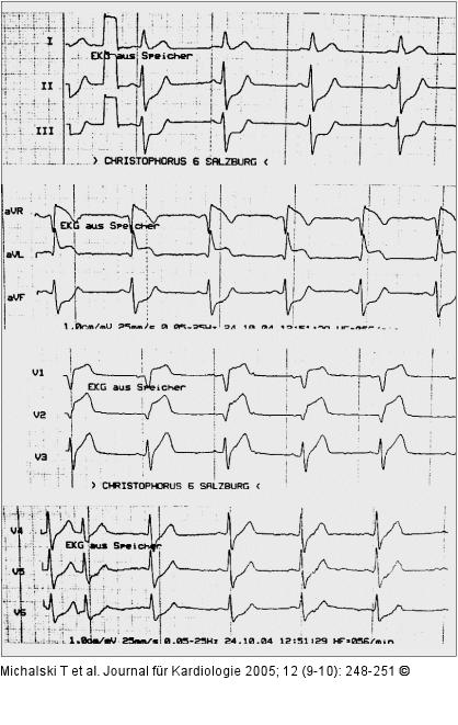 EKG