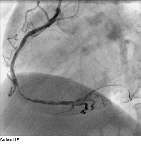Ballon - Thrombus - Stenose