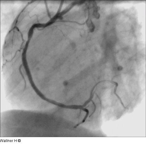 TIMI-3-Flu - Stent