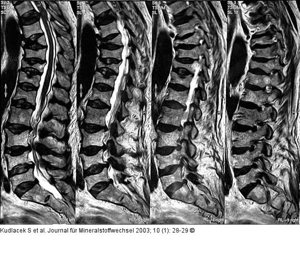 Kortison-Osteoporose