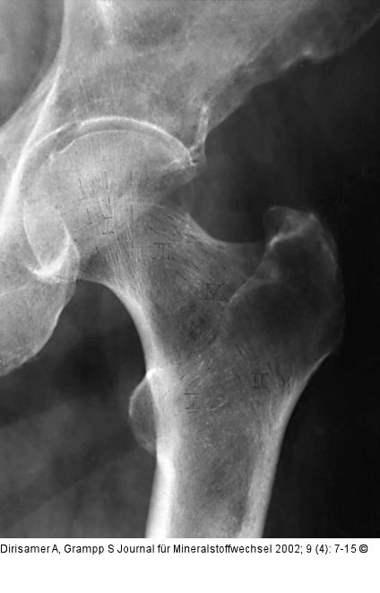 Osteoporose - Radiologie