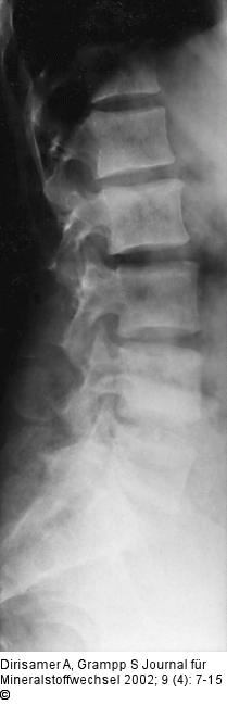 Osteoporose - Radiologie