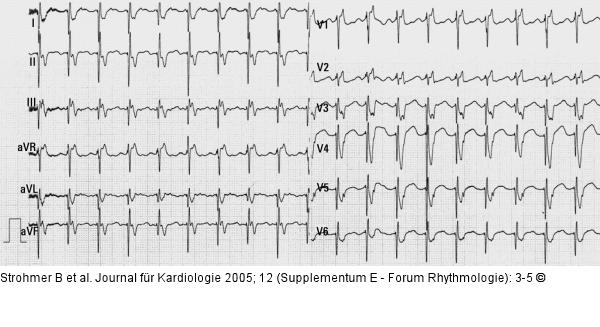 12-Ableitungs-EKG