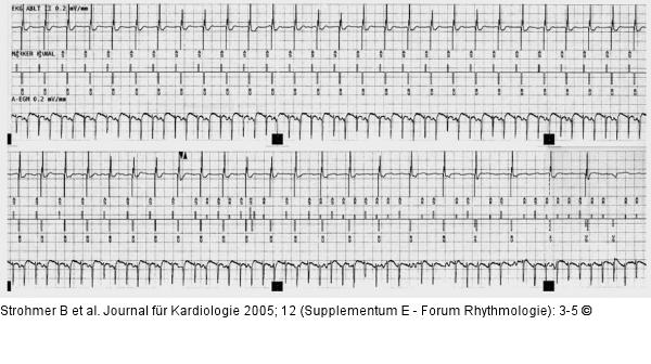 Vorhofflattern - Mode-Switch (MS)