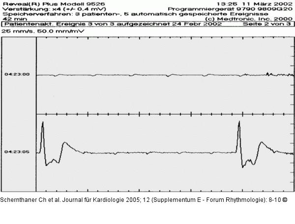 Paroxysmaler hhergradiger AV-Block