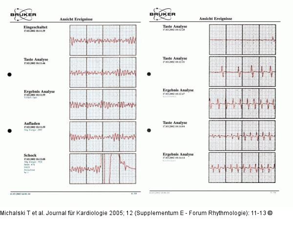 Defibrillationsbeispiele