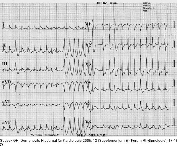 EKG