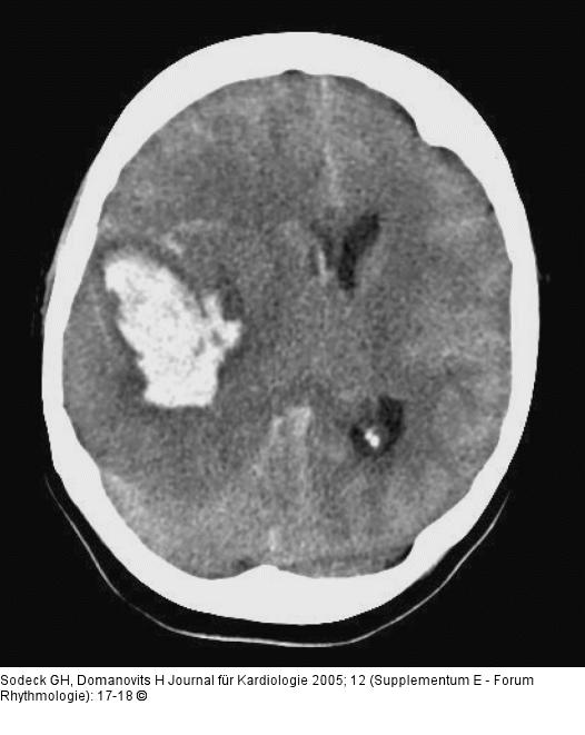 Aneurysma