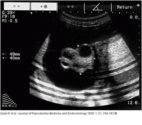 Ovary - Cyst