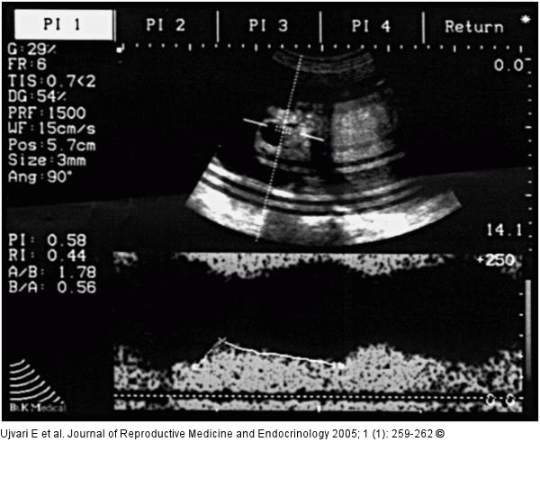 Ovary - Cyst