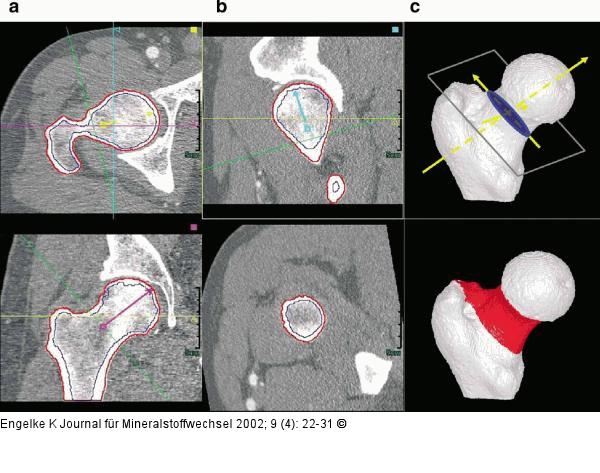 Densitometrie - Quantitative Computertomographie