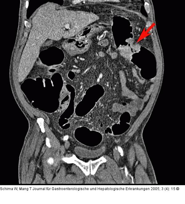 Colon descendens - Tumor