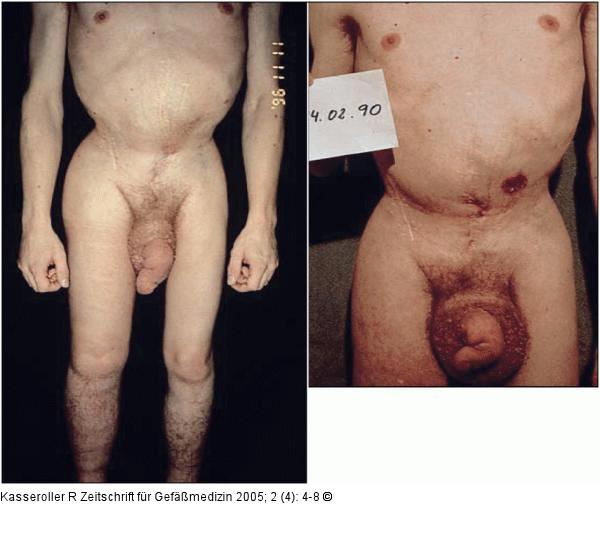 Fibrotisches Lymphdem