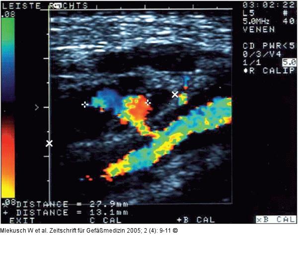 Teilthrombosiertes Pseudoaneurysma