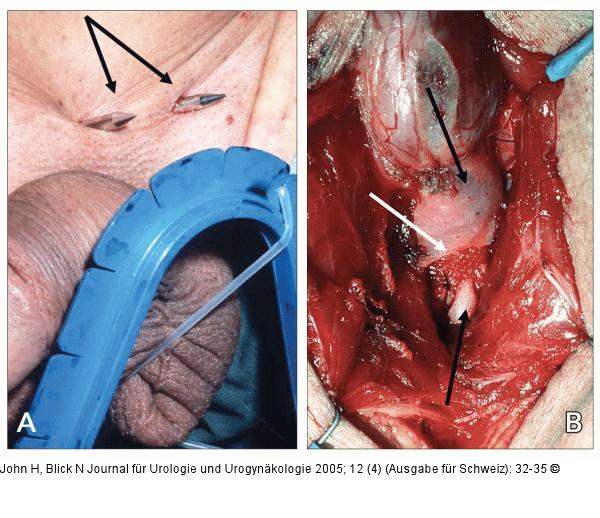 AMS-Sphinkterprothese - Operation