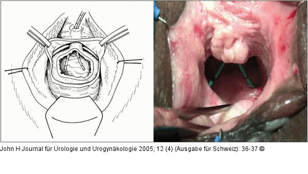 Trigonale Fistel - Urethranekrose