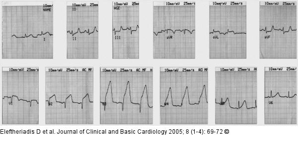 ECG