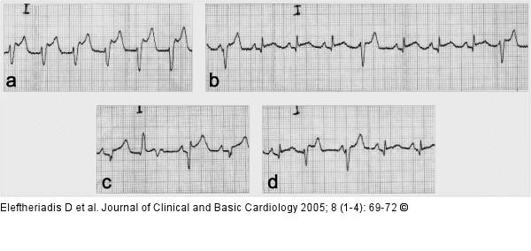 ECG - thrombolysis