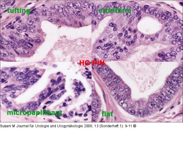 Hochgradige prostatische intraepitheliale Neoplasie