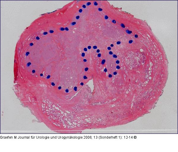 Tumor- Transitionalzone