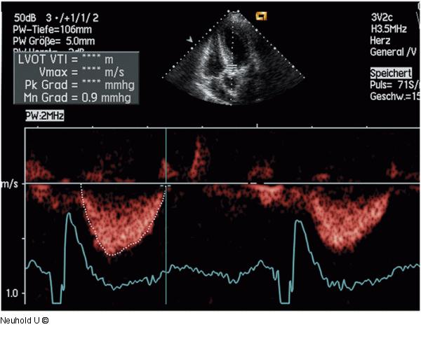 LVOT-Gradient