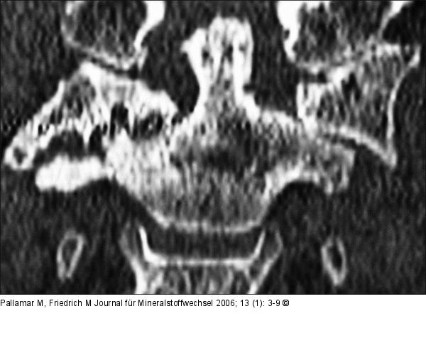 Atlas - Laterale Subluxation