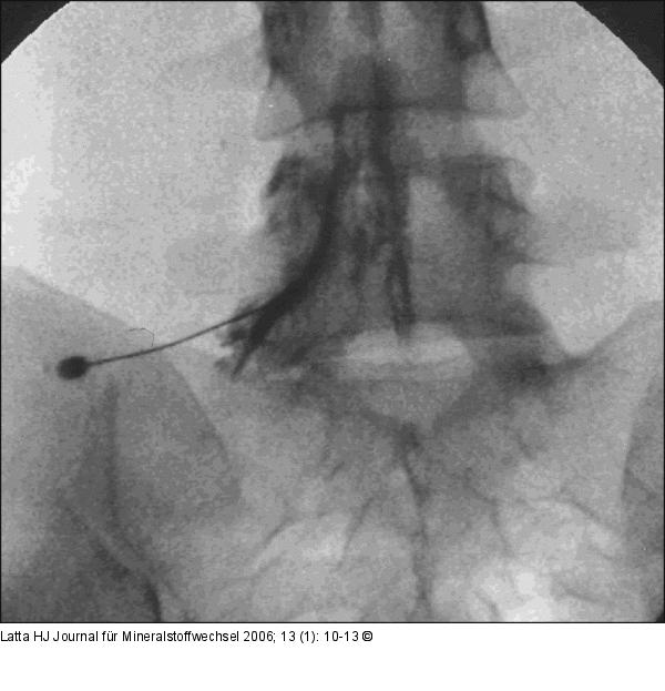 L 5 - Spinalnervblockade