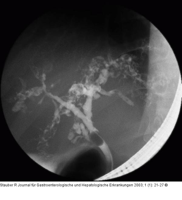 Primrsklerosierende Cholangitis