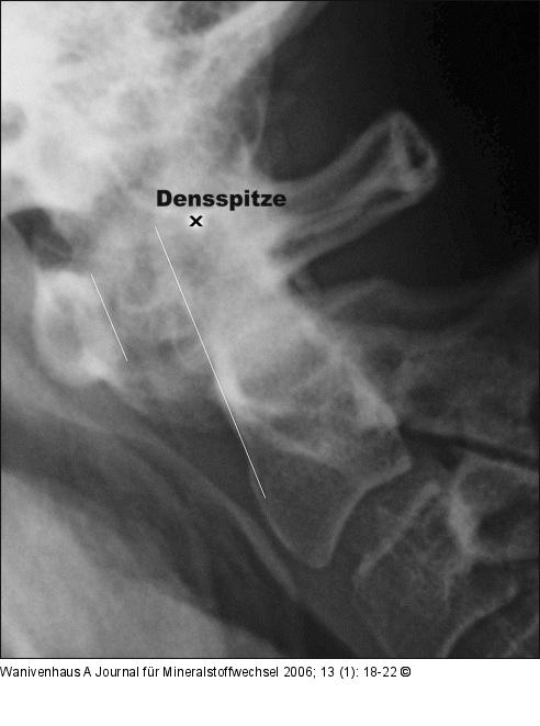 Atlantodentaldistanz