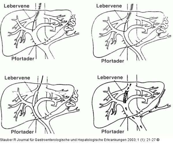 Lebervene - Pfortader - Shunt