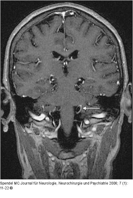 Arteria cerebelli - Nervus vagus - Nervus glossopharyngeus
