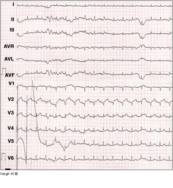 EKG